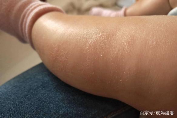 宝宝红屁股,皮疹,干燥的"克星",这个冬天给宝宝更温柔