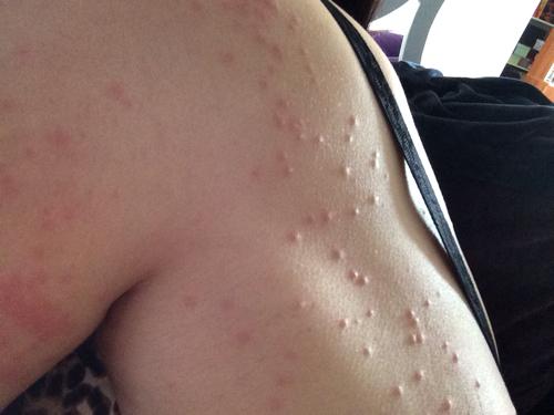 问:肩背部长了些红疹,不知道是不是湿疹啊,帮忙看看,谢谢啦