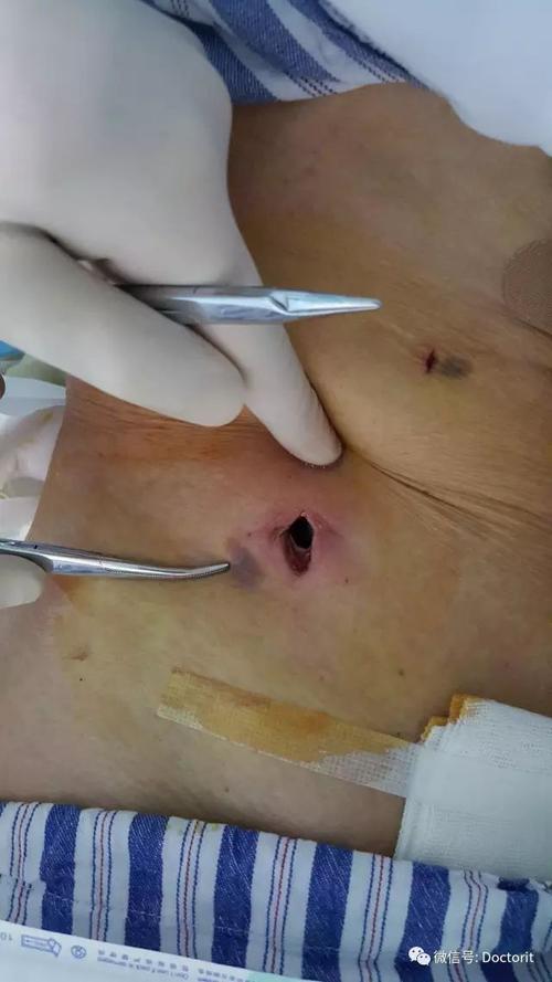 【非医勿入】腹腔引流管拔除后阑尾卡在引流管口的