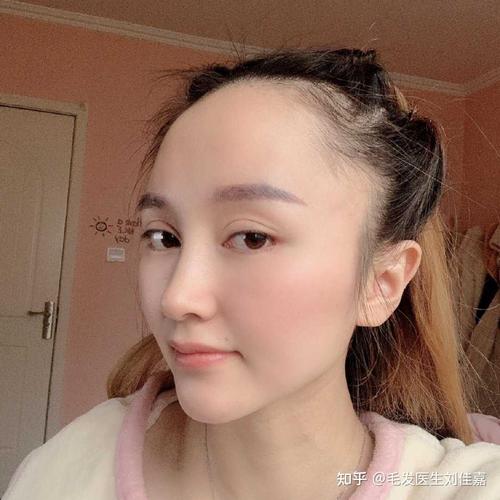 女性发际线后移显得额头宽大从而影响脸部比例及发型的可塑性这种情况