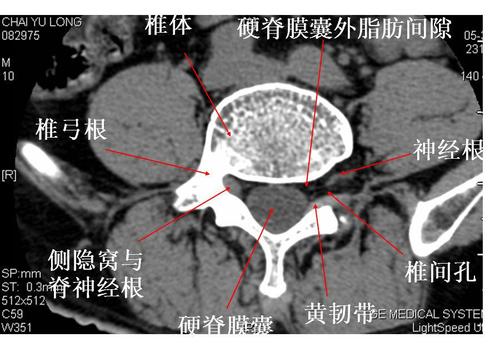收藏贴 | 颈椎,腰椎ct常见病变,你都了解吗?
