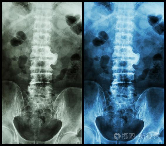 脊椎病x片x线骶椎显示脊椎病