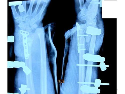 利用尺桡骨分骨术治疗桡骨远端骨折.pptx