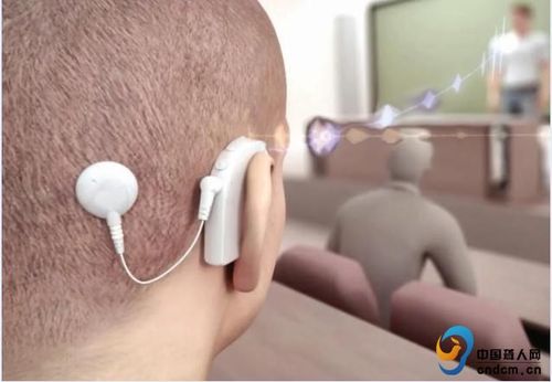 耳蜗知识 | 什么是人工耳蜗