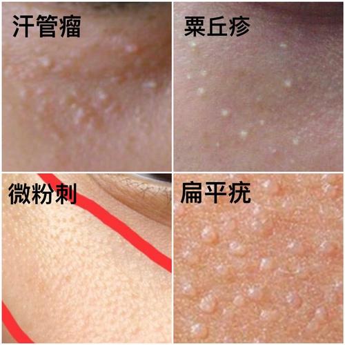 一张图区分汗管瘤,粟丘疹,微粉刺,扁平疣