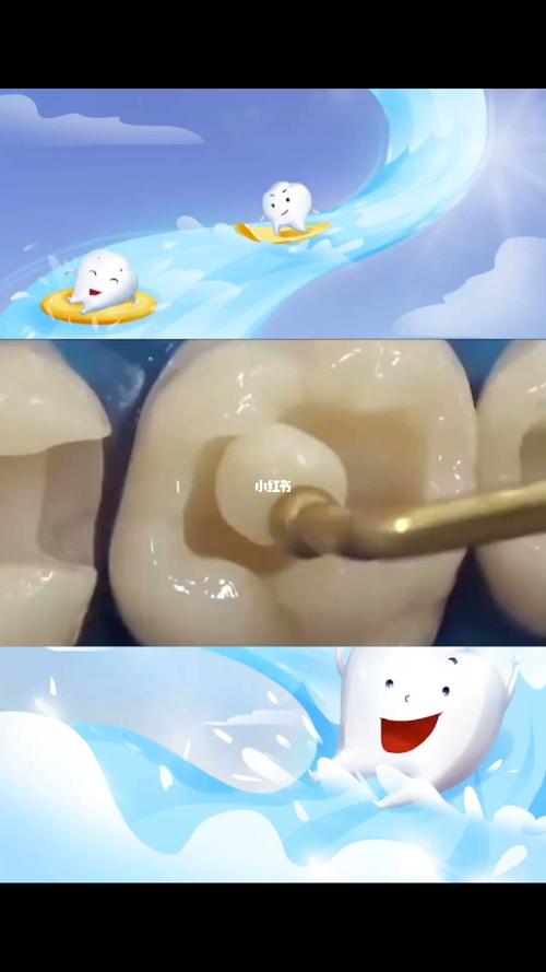 口腔科普 #补牙过程_补牙_口腔_补牙过程_医疗健康