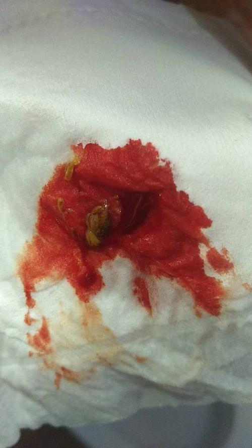 便血是这种样子会不会是直肠癌 有点脓血 图片上有