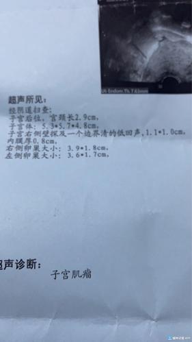 [试管婴儿]子宫腺肌症,自然怀孕两次流产