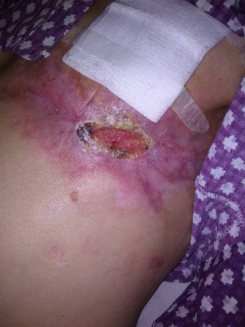 乳腺癌乳房切除术不缝合是什么类型的手术?没什么不用缝合?