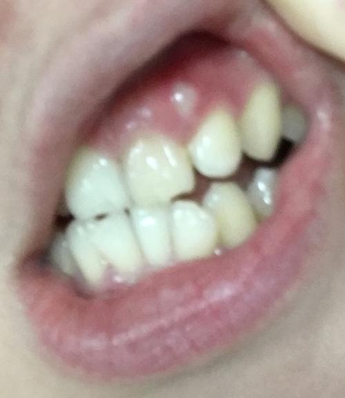 牙龈上白色的硬包凸起 好长时间了之前一直也不疼 啥感觉也没有 这几