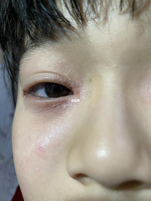小朋友眼角起皮,有碰到这样的吗_小朋友_药膏_母婴