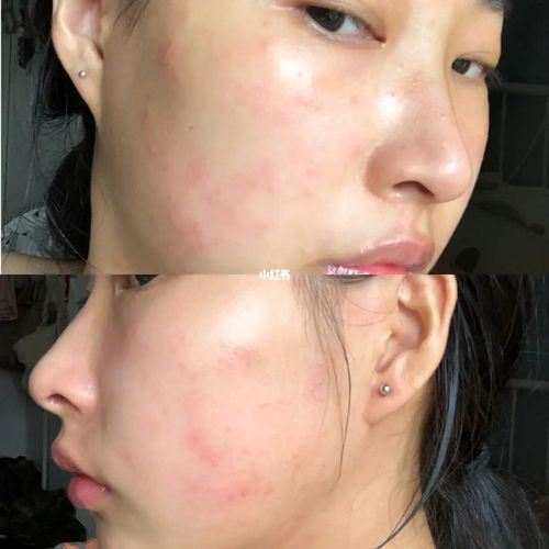 记录一下过敏性皮炎变成激素脸全过程_激素脸_过敏_皮炎_药膏_理肤泉