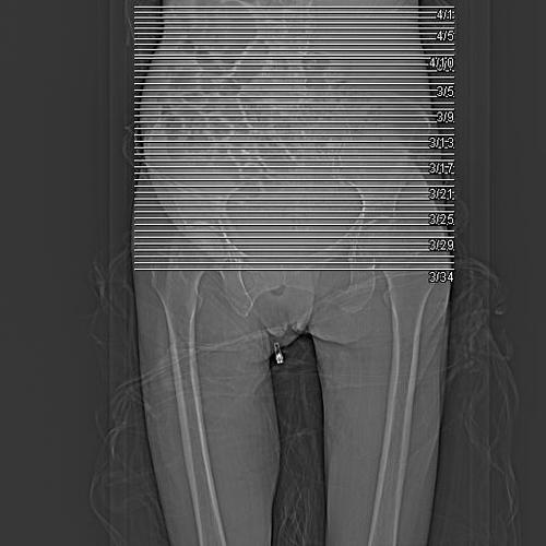 ct42306:女性,78岁下腹部膨隆数月.