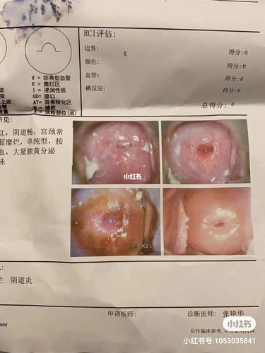 宫颈糜烂没做手术修复好了,真心感谢它_宫颈糜烂_私密