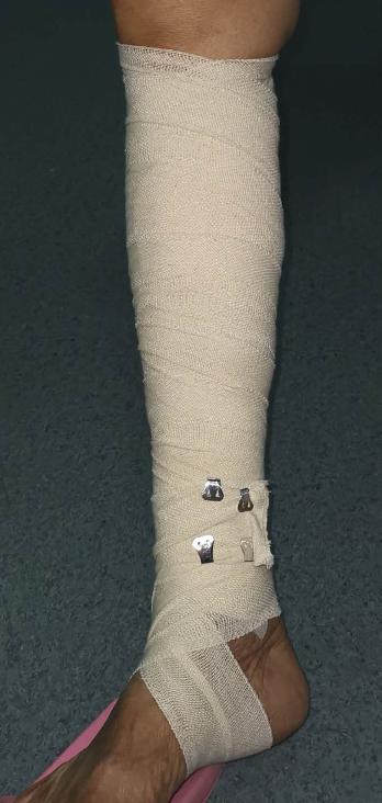 泡沫硬化包扎后就可步行,不影响行动