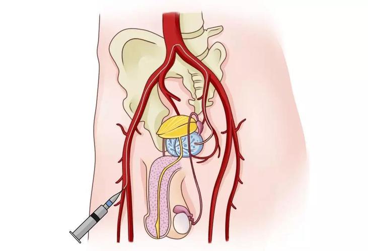 介入治疗——前列腺动脉栓塞术