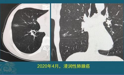 肺纤维灶是什么意思?会长成肺癌吗?该怎么办更安全?