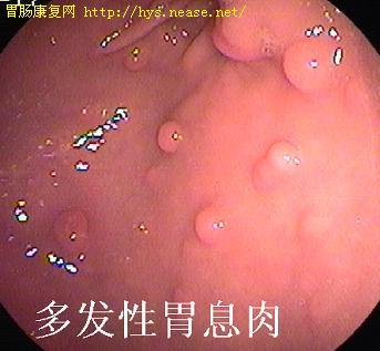胃镜图片-胃息肉
