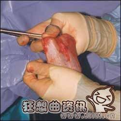 男变性女手术过程图解 变性手术恶心慎入