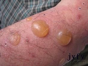 病理原因/天疱疮 编辑