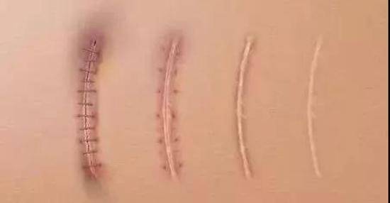 而伤口长得好与会不会留疤没有直接联系,因为伤口愈合和疤痕形成是两