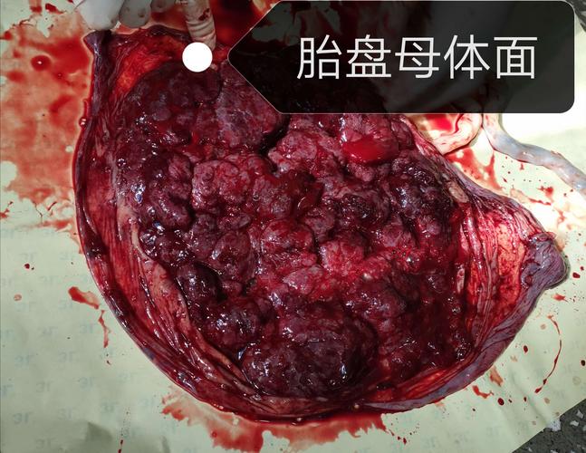 胎盘的异常表现