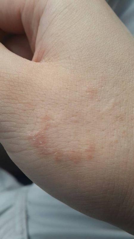 手上这个是什么?是癣吗?还是什么?是什么廯?一年了,都