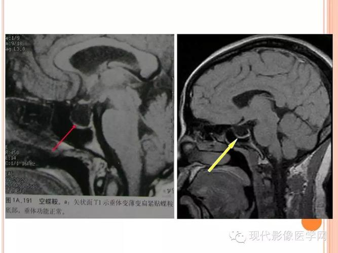 空蝶鞍综合征