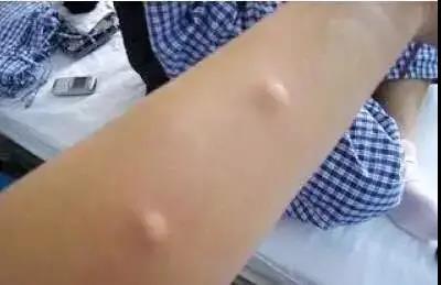 什么是皮脂腺囊肿?什么是脂肪瘤?