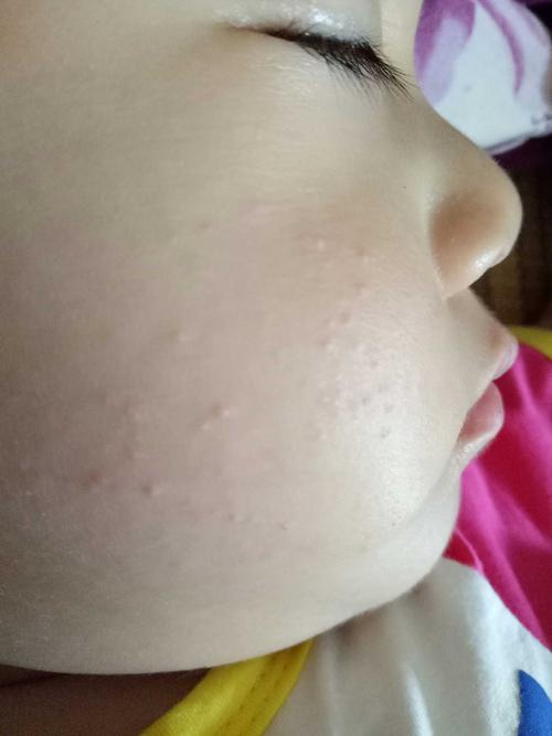 宝宝脸上两边长着像脂肪粒的东西怎么去除