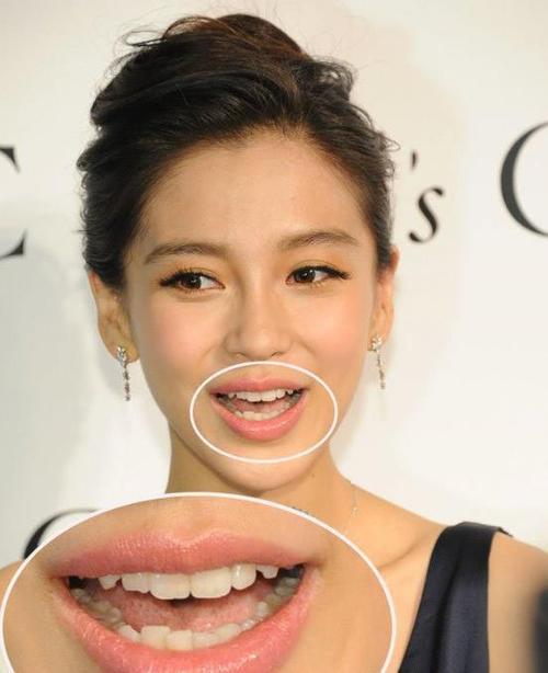 明星整牙整的最失败的一个angelababy做烤瓷牙老十岁