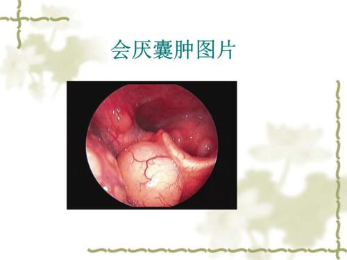 会厌囊肿讲座概览.ppt