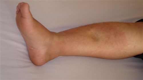 大叔下肢浮肿原来是肺癌的肺癌表现