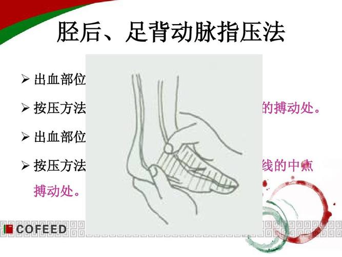 止血 包扎 搬运 固定 胫后,足背动脉指压法   出血部位:足底(胫后动脉