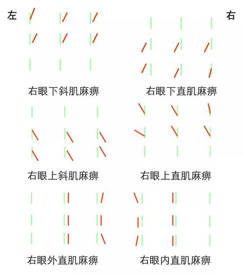 斜视手术后会复视吗?