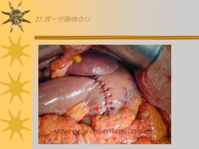 胰十二指肠切除术ppt