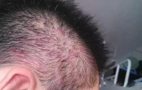 头皮毛囊炎又肿又疼,究竟是什么导致反反复复?