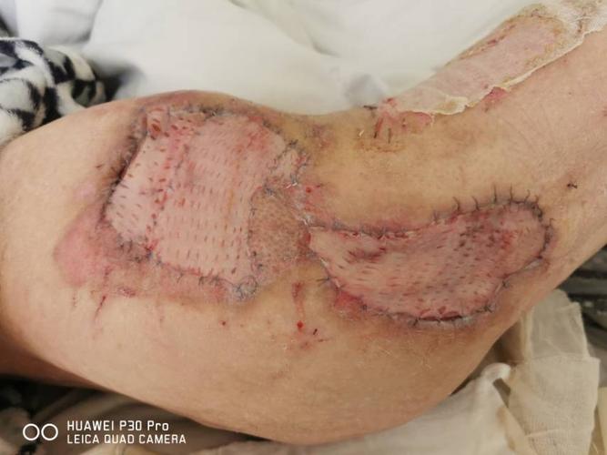 植皮术后6天,患者移植皮肤全部成活,髋部外露创面全部修复,患者痊愈