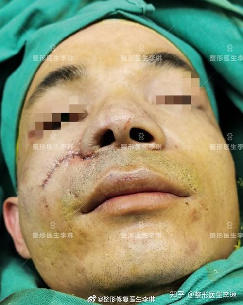 鼻翼再造术——男子幼年右鼻翼烧伤造成鼻翼缺损#李琳