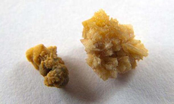 泌尿系结石的独白