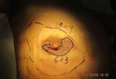 乳晕上做切口是极大的错误,破坏了乳晕的完整性.