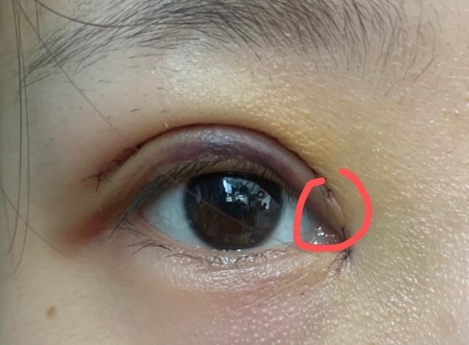 全切内眼角|求助帖!眼角有个小疙瘩 呜呜呜