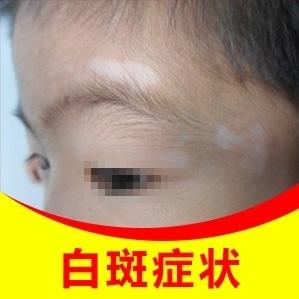 烟台半岛医院专家表示:早期白癜风色素脱失少,病情轻.