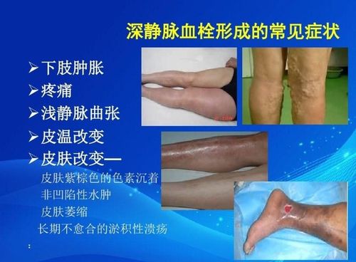 血管讲堂-下肢深静脉血栓(上篇)