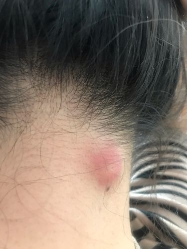 一个火疖子的自述