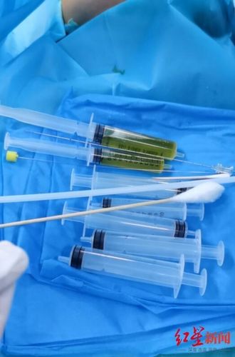 胎儿大量胸腔积液压迫肺部 医生在妈妈肚子上扎了一针