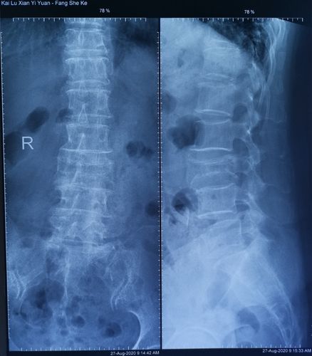 85岁腰椎压缩性骨折椎体成型手术一例