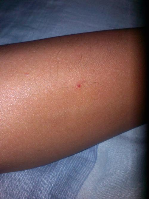 就是今天看到艾滋病的事也看到自己手上有小红点,就是怕