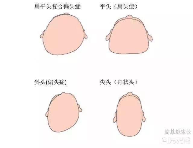 扁平头复合偏头症 网上查了一直这样对孩子