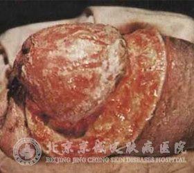 复发性二期梅毒症状